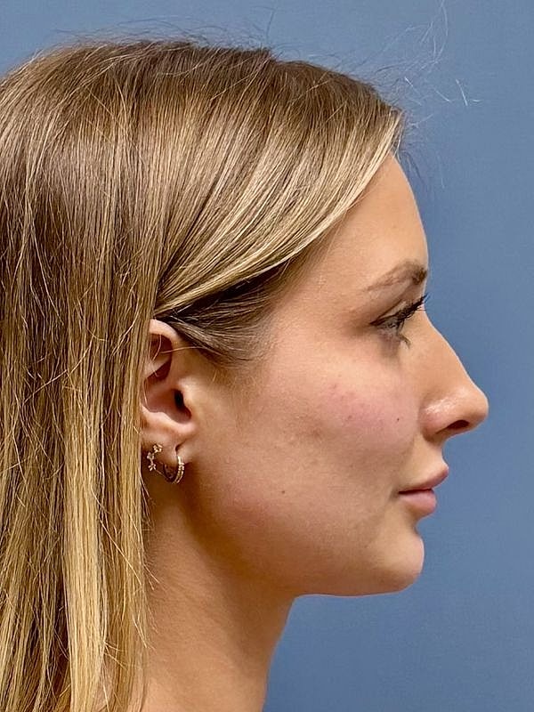 Dermal Filler/Facial Balancing Before & After