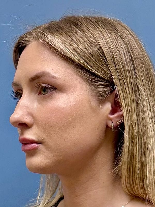 Dermal Filler/Facial Balancing Before & After