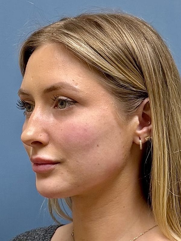 Dermal Filler/Facial Balancing Before & After
