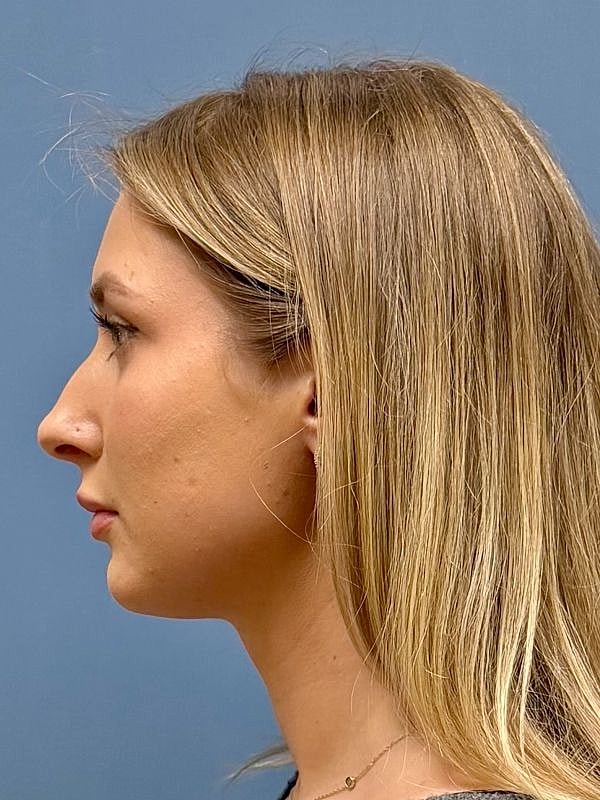 Dermal Filler/Facial Balancing Before & After