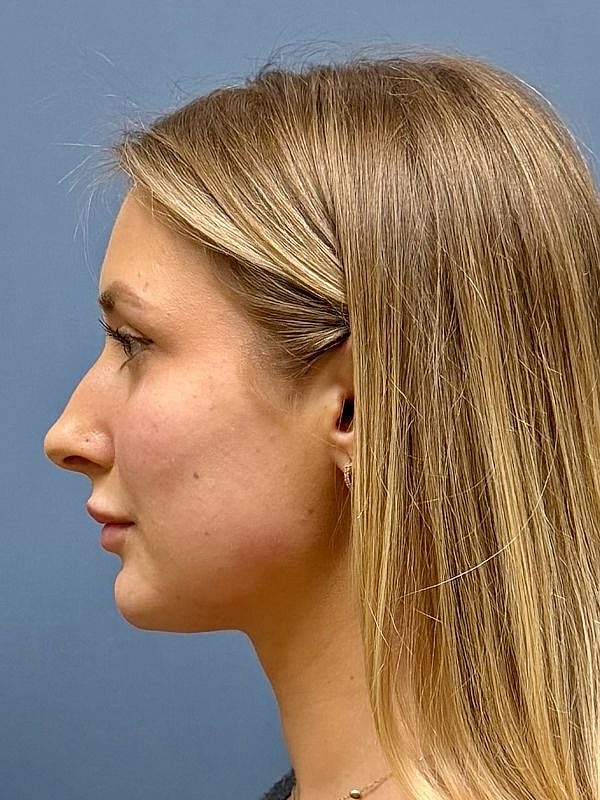 Dermal Filler/Facial Balancing Before & After