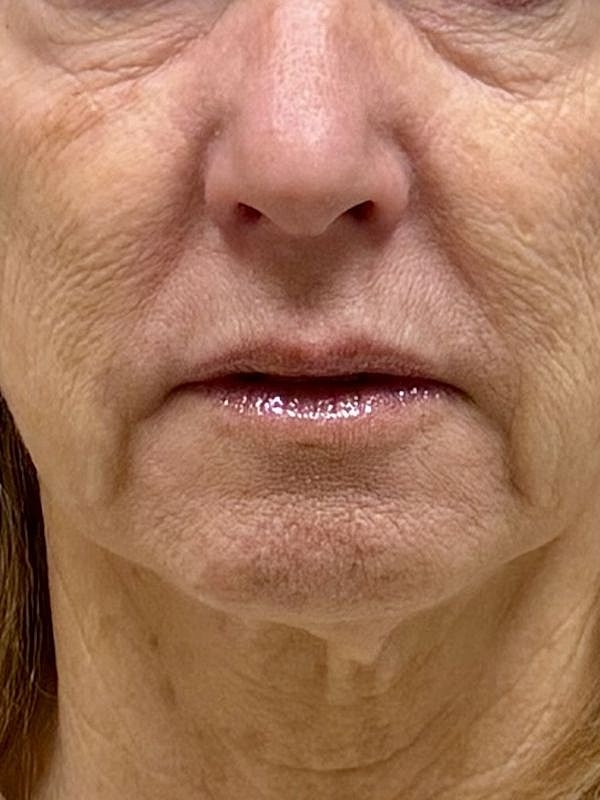 Sculptra Before & After