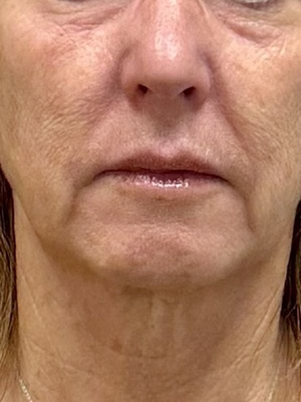 Sculptra Before & After