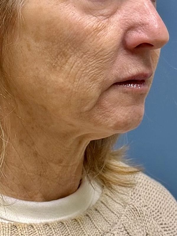 Sculptra Before & After