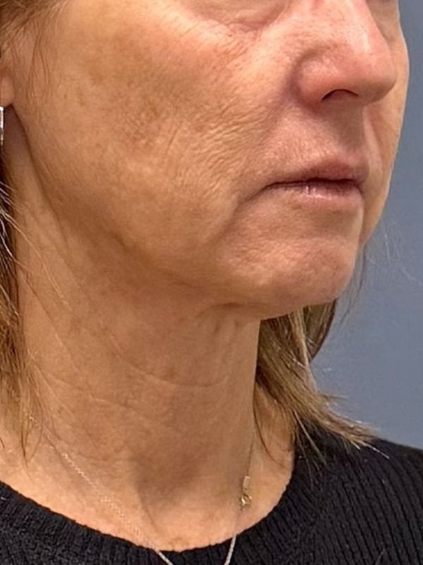 Sculptra Before & After