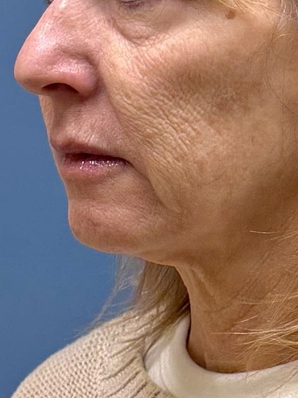 Sculptra Before & After
