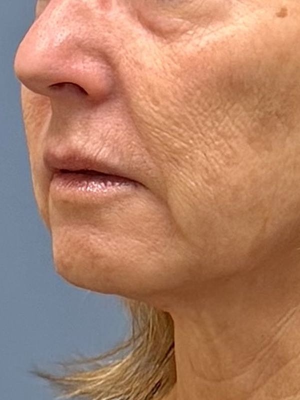 Sculptra Before & After